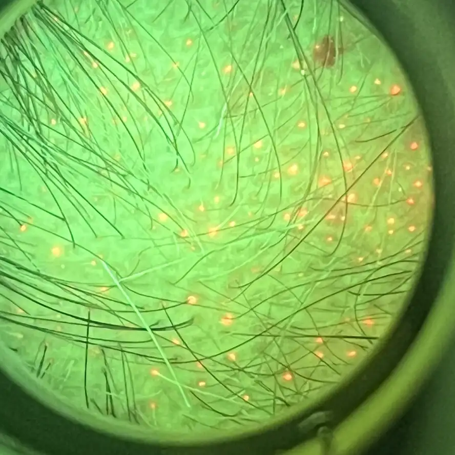 Mapeamento fluorescente do couro cabeludo — imagem 4